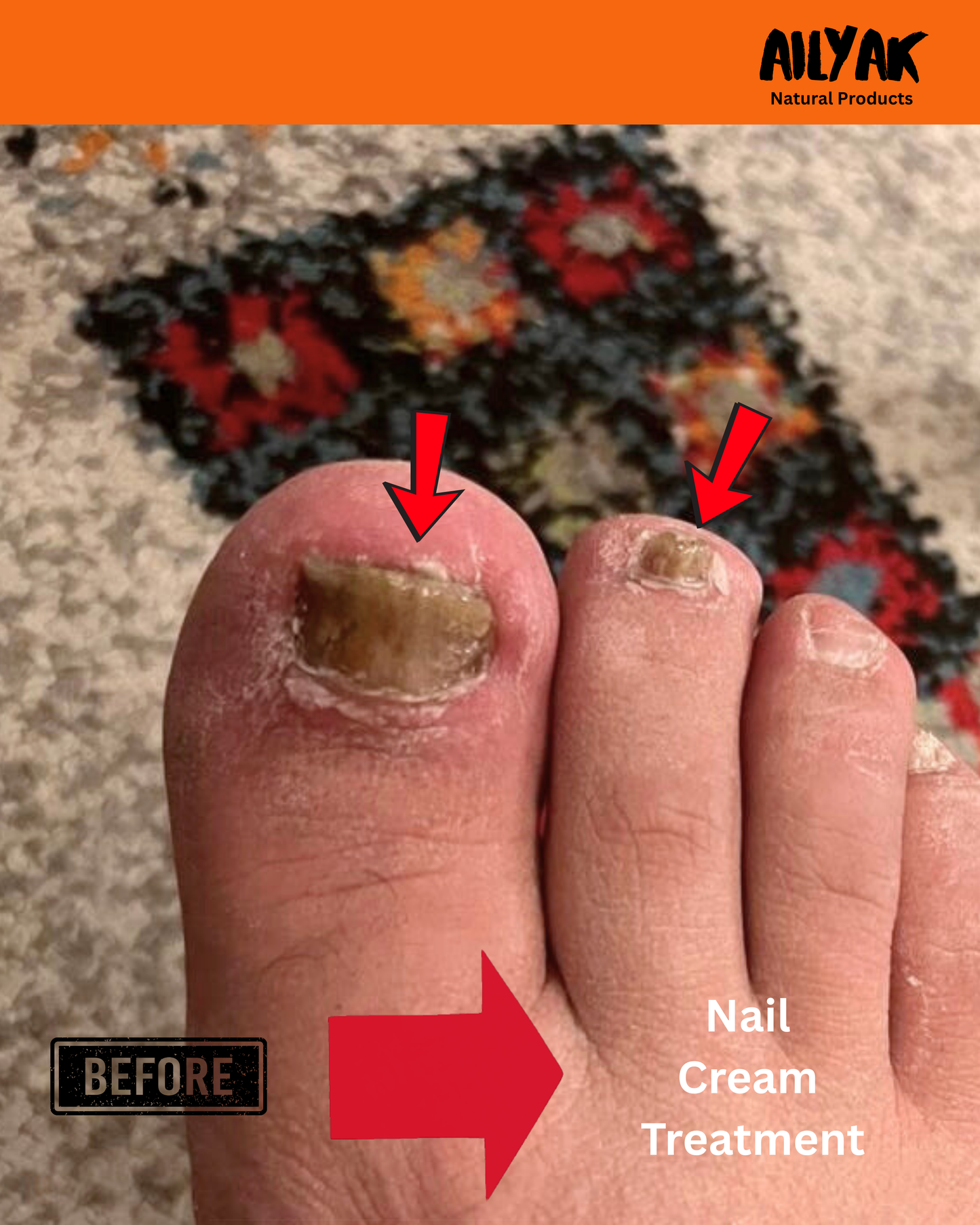 Nail Cream -علاج الاظافر