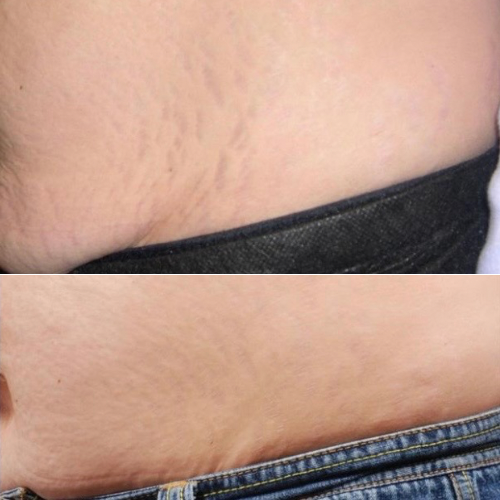 Stretch Marks cream-تشققات البطن