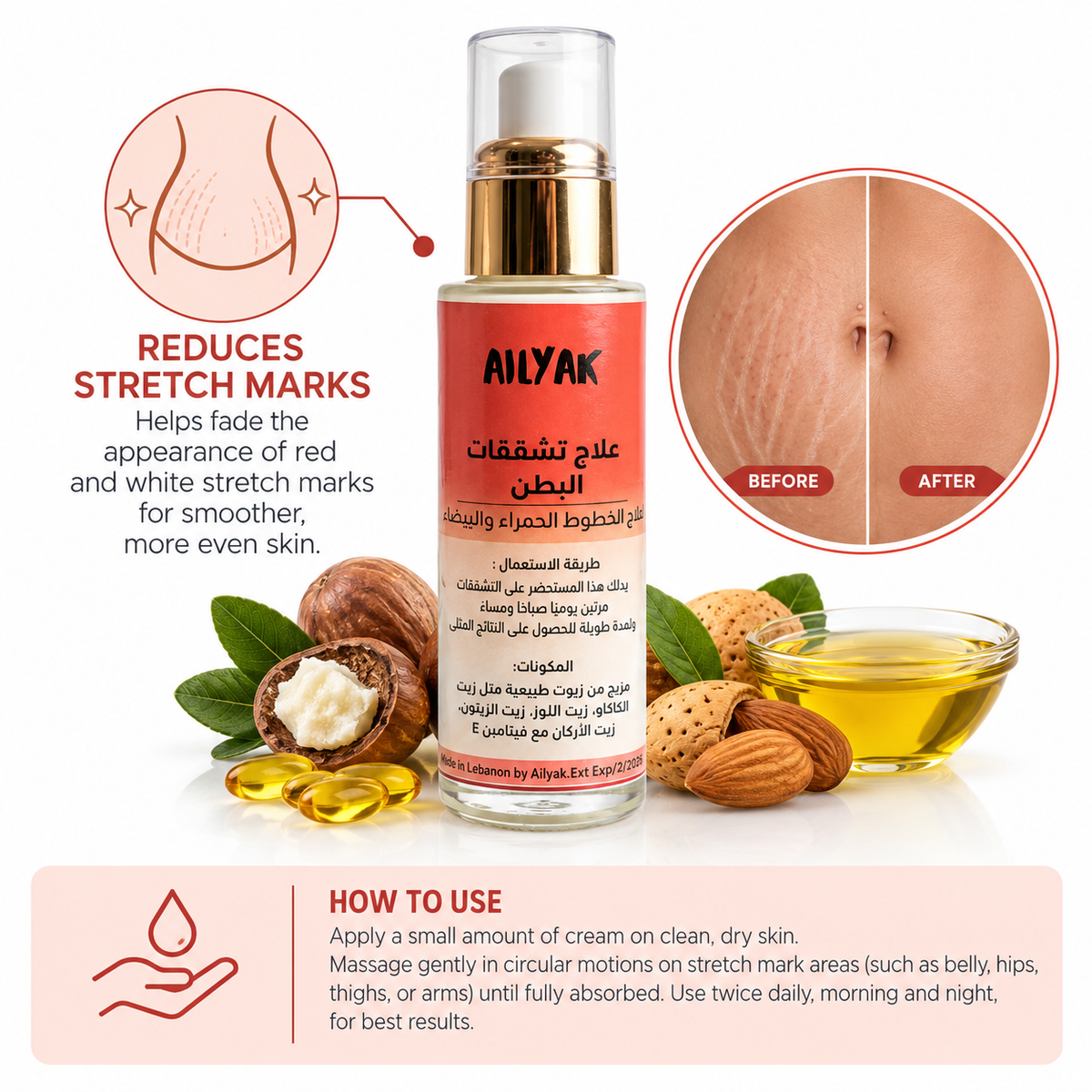 Stretch Marks cream-تشققات البطن