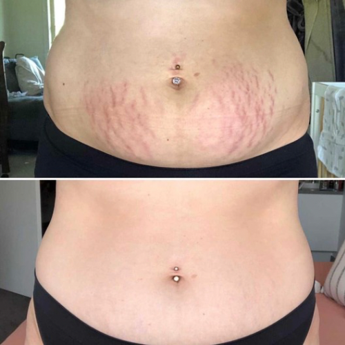 Stretch Marks cream-تشققات البطن