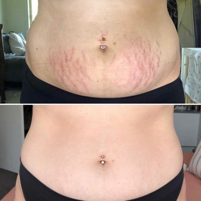 Stretch Marks cream-تشققات البطن