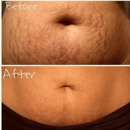 Stretch Marks cream-تشققات البطن
