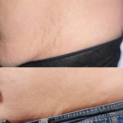 Stretch Marks cream-تشققات البطن