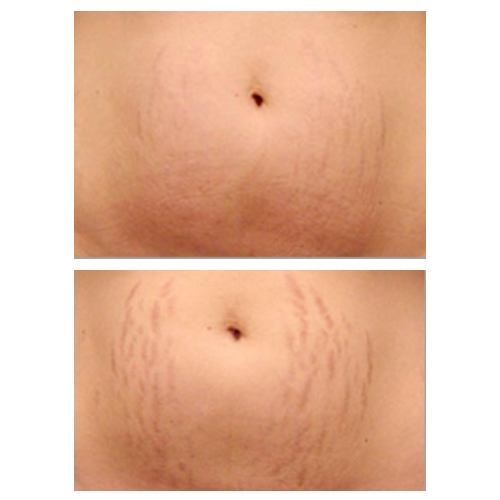 Stretch Marks cream-تشققات البطن