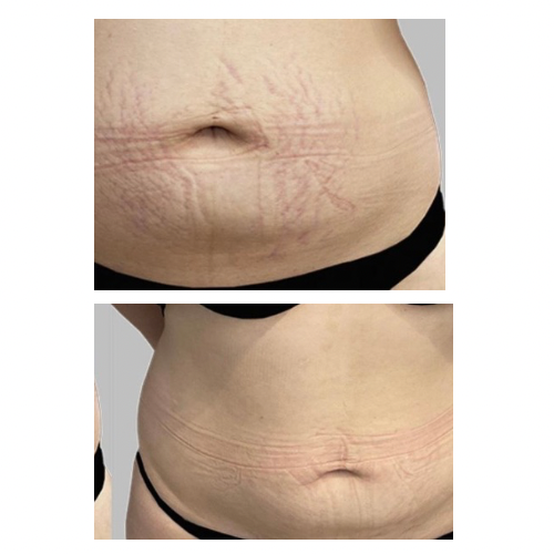 Stretch Marks cream-تشققات البطن