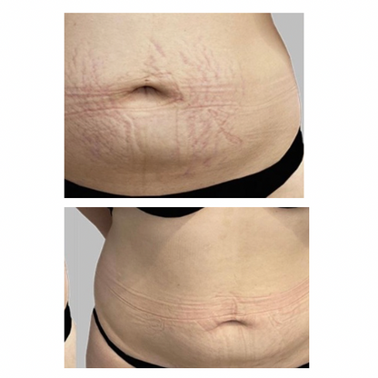 Stretch Marks cream-تشققات البطن