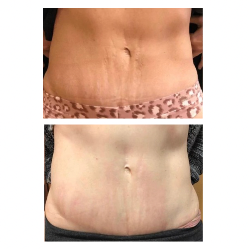 Stretch Marks cream-تشققات البطن